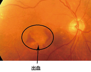 加齢黄斑変性