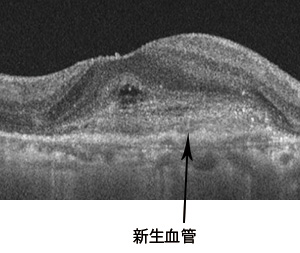 加齢黄斑変性